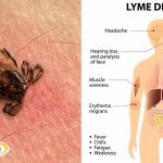 Lyme Disease – An All-round Challenge